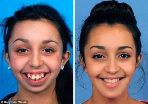 el-cambio-radical-de-una-chica-tras-operarse-la-dentadura-y-mandibula-se-vuelve-viral-foto-1-2016