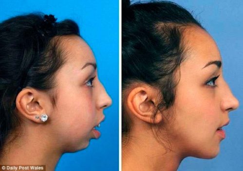 el-cambio-radical-de-una-chica-tras-operarse-la-dentadura-y-mandibula-se-vuelve-viral-foto-2-2016