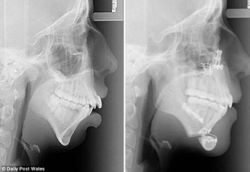 el-cambio-radical-de-una-chica-tras-operarse-la-dentadura-y-mandibula-se-vuelve-viral-foto-3-2016